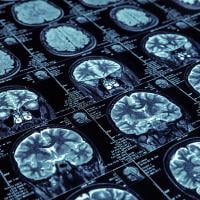 Scientists develop high-resolution molecular maps of Alzheimer’s and related brain disorders